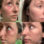 Image of before and after the use of bioactive complex and restore
